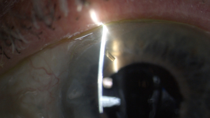 Glaucoma