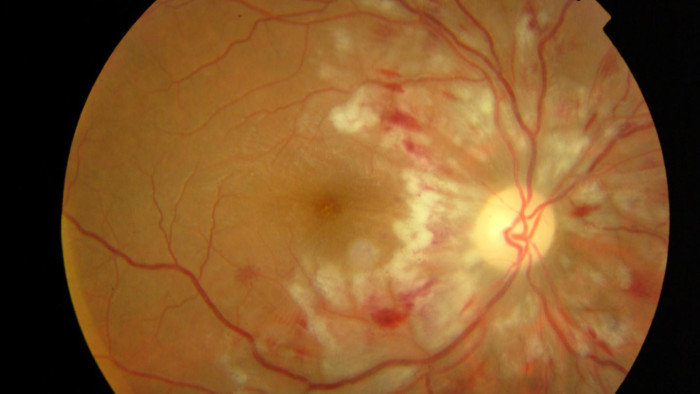 Retinopatía de Purtscher