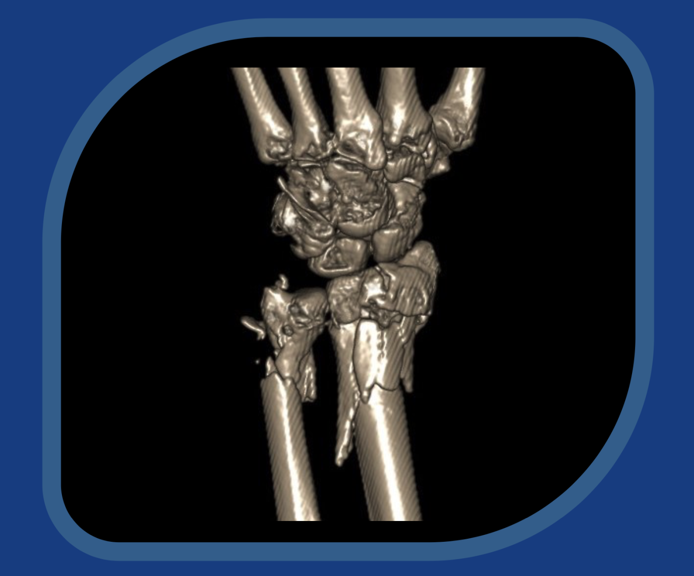 Imatge d'una fractura de canell