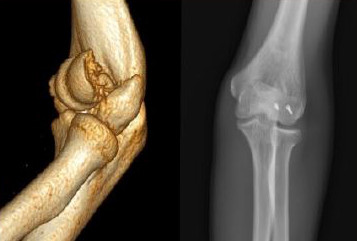 Fractures