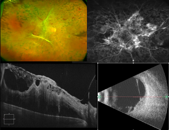 Retina