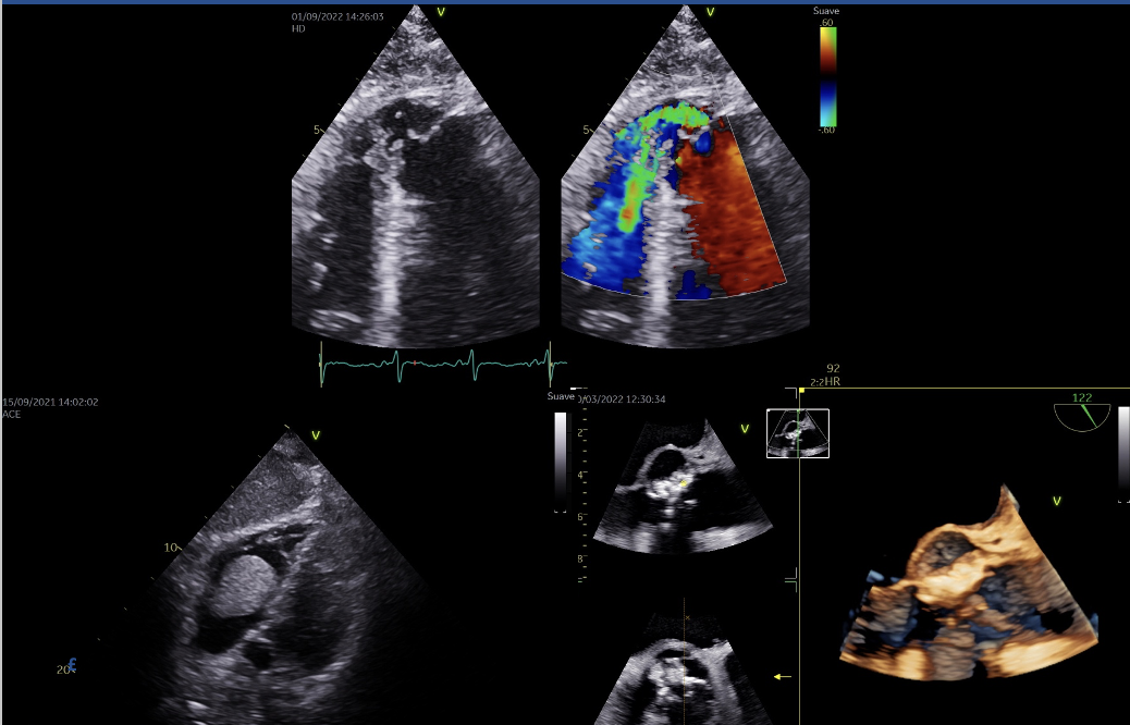  XX Curs teòric - Pràctic de Ecocardiografia Bàsica i Avançada en Medicina de Urgència, Intensiva i Anestesia