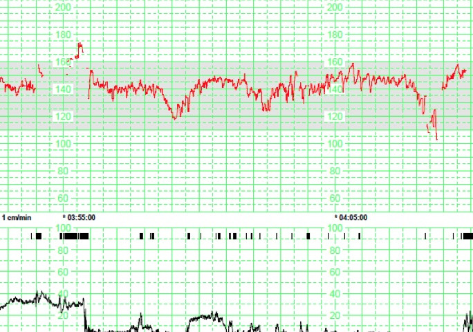III CURSO  REINTERPRETACIÓN DEL REGISTRO CARDIOTOCOGRÁFICO