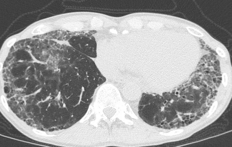 curso-simulacion-clinica-avanzada-enfermedades-pulmonares-intersticiales