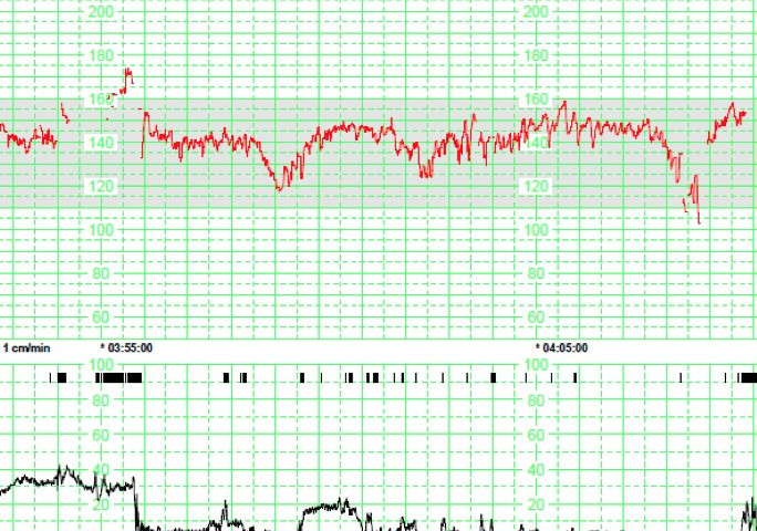 cardiotocografico