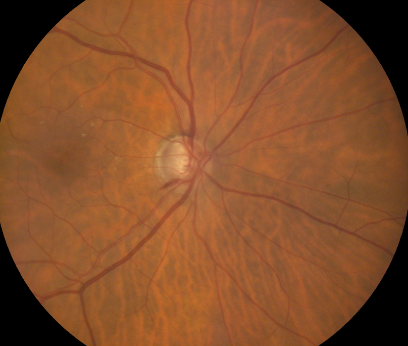 PRIMER TALLER DE GLAUCOMA