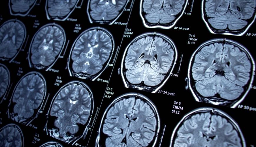 Radiografies de cervells humans